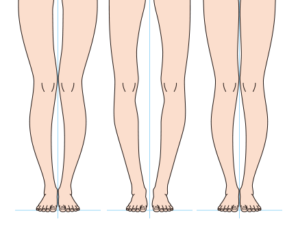 O脚の種類